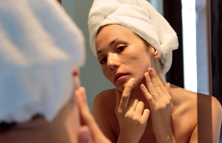 Can Hard Water Cause Breakouts? What You Should Know